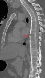 Uppkomsten av cauda equina-syndrom orsakas i de flesta fall av ett stort centralt diskbråck. Bland övriga orsaker kan nämnas spinal stenos och primära tumörer/metastaser samt spinala infektioner [5].