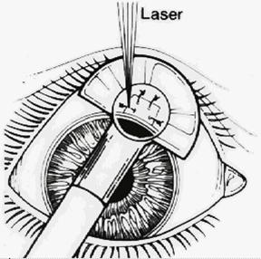 Lasersuturolys Brännande