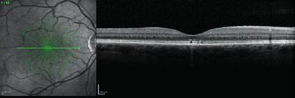 Vid avbildning av ögats främre segment är upplösningen i längdaxelns riktning 10 µm och transversalt 30 µm.