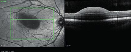 Det kan ibland vara svårt att kliniskt skilja mellan retinoschis och näthinneavlossning.