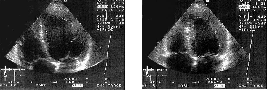 För diagnos av HFpEF (HFmrEF) 1. Symtom och tecken på hjärtsvikt 2. Ejektionsfraktion > 40 % 3. Förhöjt NT probnp 4.