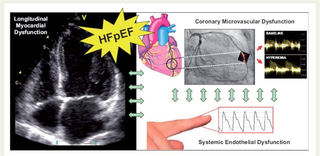 Mikrovaskulär dysfunktion BA 2018 Shah SJ, et al. PROMIS HFpEF. Eur Heart J 2018;39(37):3439 3450.