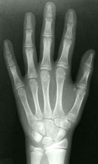 Allmänt om metacarpalefrakturer Fraktur på ett av metacarpalebenen (mellanhandsbenen) är en vanlig typ av handskada.