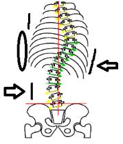 Methods: A review of PT and OT records from all children fitted with scoliosis braces during 2003-10 Divided into groups: Sitting ability (LSS) Walking ability (GMFCS, Hoffer or Vignos) Degree of