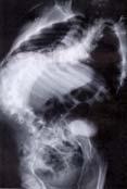 Mätning av Cobbvinkel Röntgenbild med ett års mellanrum ryggen kollapsar Föreningen Sveriges