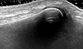 DRU longitudinellt Proximalt Distalt Synovia DRU U Hand med palmarsidan platt på bordet, underarm och långfinger