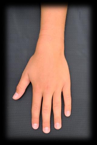 ECU transversellt Hand med palmarsidan platt på bordet, underarm och långfinger bildar en linje.