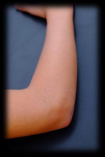 Armbåge: Posteriort longitudinellt Proximalt Distalt Triceps Patienten sitter mittemot läkaren.