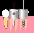 IMPLANTATSKJUTMÅTT Caliper Marknadens smartaste implantatguide Passar alla