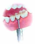 C7 TN CA IPCT TN Mycket tunn GINGI RETRACTOR Skyddar gingivan vid PREP Ett set består av ett handtag + ett litet och ett stort blad.