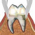 13 21 22 79 ROBA Witzel Universal rot 81-700-10Z ROBA 13 UK Premolar 81-213-00Z ROBA 21 UK