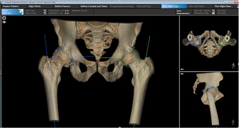 Om Ortoma Ortoma utvecklar operationssystem för planering och positionering av implantat vid höftleds-, knäleds- och ryggkirurgi.