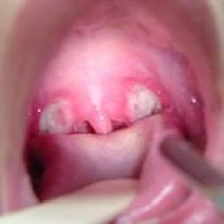 Faryngotonsillit Barn under 4 år sällan bakteriell tonsillit.