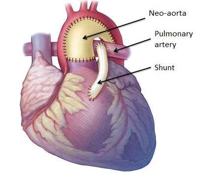 Steg I neonatalt: Norwood + shunt till lungartärer Ett säkert utflöde till en gemensam systemartär skapas.