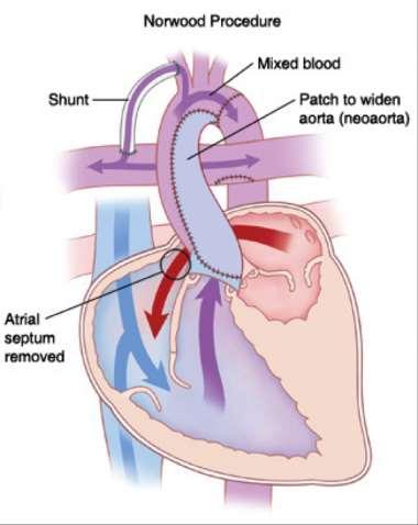 förmaksförbindelse krävs för oobstruerat lungvensflöde och blandning av lungvenöst och systemvenöst blod.