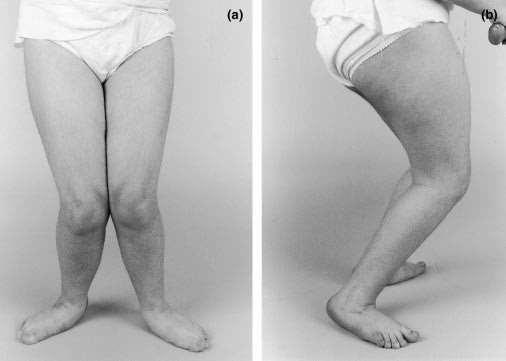 Fler variabler i 3 plan på knäande gång: Deformitet av ben: medial femur torsion lateral tibia torsion (mid foot breaching) Fot i uttalad planovalgus