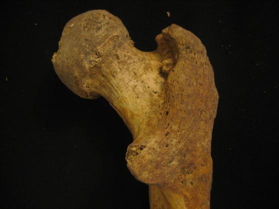 Bild 5: Detta är lårbenet från grav 51 som visar bentaggar samt förändringar som kan bero på osteoartrit. Foto: Julia Bonds 2012.02 6.1.23 Grav 52, dnr 220-437-1998 Kön:?
