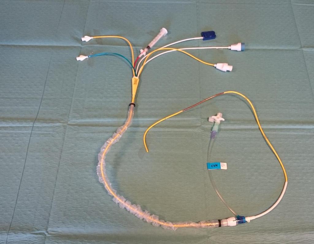 Bilaga 1 Gul lumen Distal lumen. Mynnar i a. pulmonalis distalt om ballongen. Används för mätning av PA-tryck (PAP) och provtagning för blandvenös blodgas.