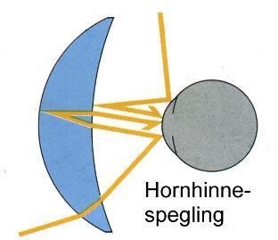 Hornhinnereflexer Dessa reflexer märks främst på kvällen då ljus kastas från hornhinnan mot linsernas främre- och bakre ytor tillbaka in i ögat. De uppkomna dubbelbilderna syns då mot mörk bakgrund.