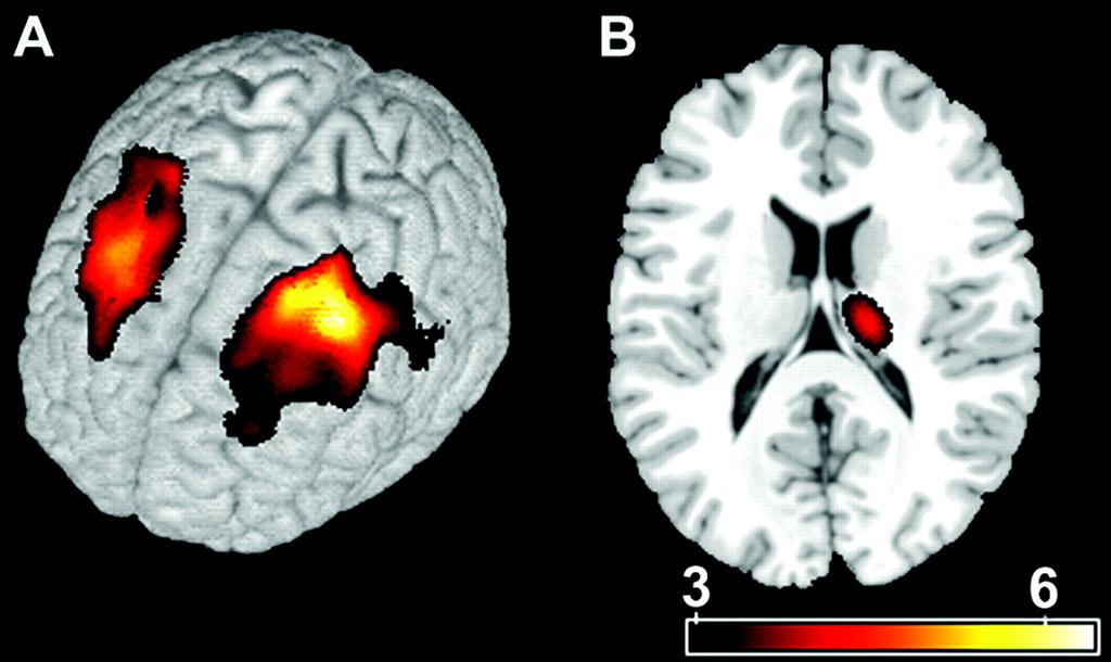 Figure 2. Regional gray matter density decreases in CBP subjects Apkarian, A. V.