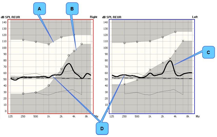 A. UCL B. Audiogram C. Topp runt 3 khz D. Mätningskurva 13.