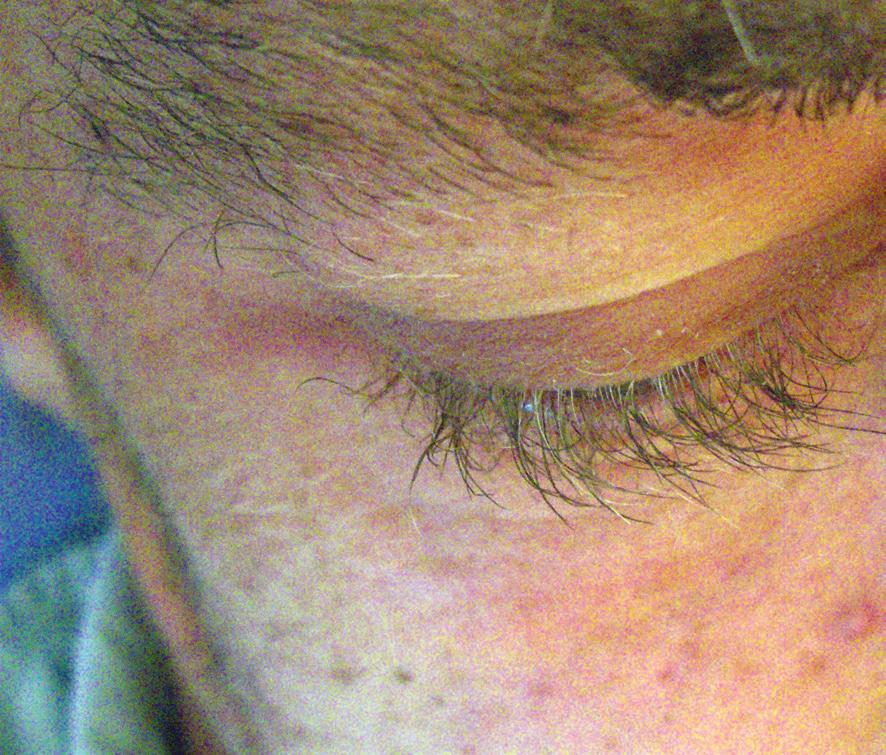 Hår Det ses ofta en ökad växt av ögonfransar. Hårstrukturen kan förändras.