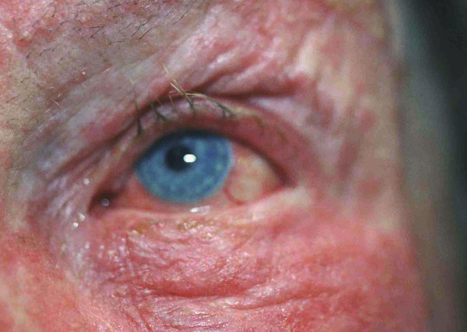 Torra ögon och/eller irritation i ögonområdet Området runt ögonen smörjes med mjukgörande, exempelvis Miniderm (svider ej) eller salva Protopic 0,1% 2 gånger per dag.