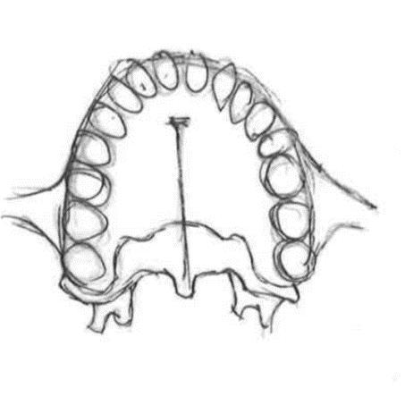 Os palatinum Detta ben kan liknas vid bokstaven L och utgör bakre delan av hårda gommen. Markera hårda gommens ben i Figur 14.