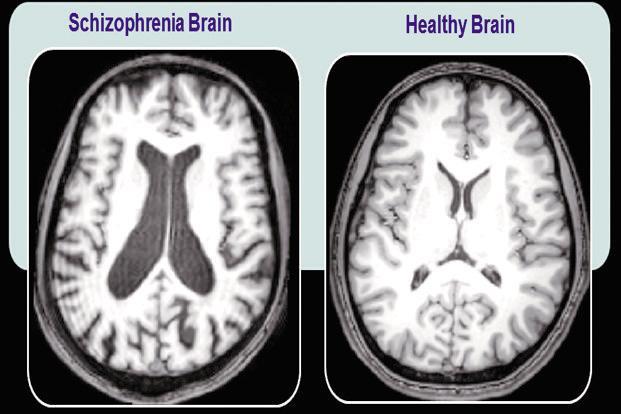 Strukturella förändringar vid schizofreni Minskad total hjärnvolym och vidgade ventrikelsystem. Minskad volym framförallt temporalt, frontalt och subkortikalt i hjärnan.