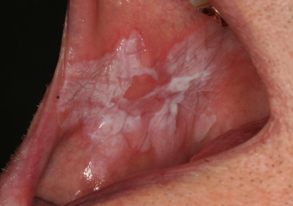 Leukoplaki Patient fall 1