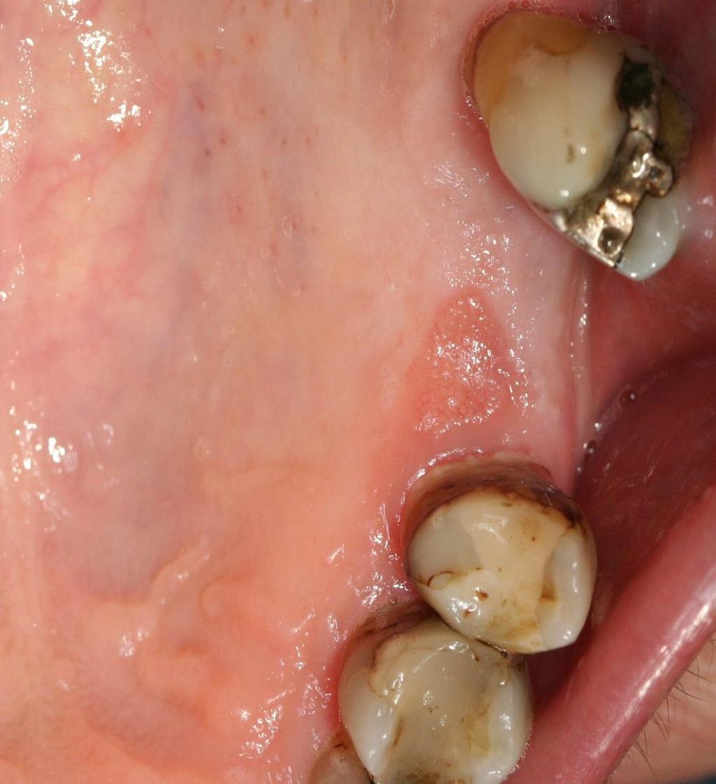 26 grav parodontit,, 26 exad,