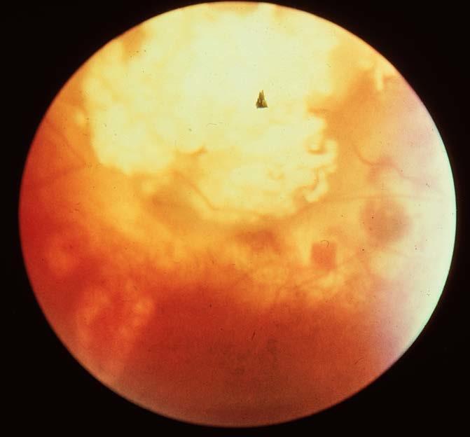 Retinoblastom Enda maligna tumören som utgår från retina. Cirka 5 fall/år i Sverige, de flesta debuterar före 3 års ålder.
