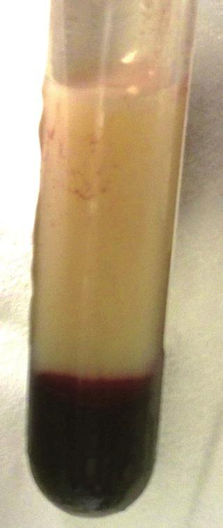 Figure 1. Milky serum of the blood form a leukemic patient.