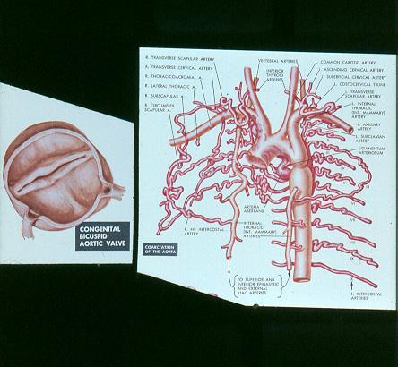 Bikuspid aortaklaff