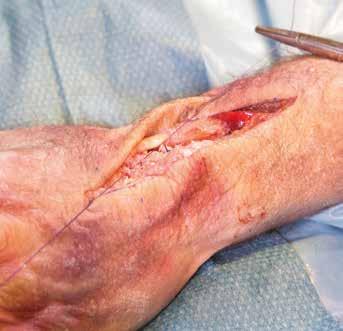 11. Använd ben för att fylla handledskaviteten 12. Tillslutning Dorsalkapseln tillsluts. Extensor retinaculum sutureras tillbaka på plats och ett subkutant drän läggs in innan snittet tillsluts.