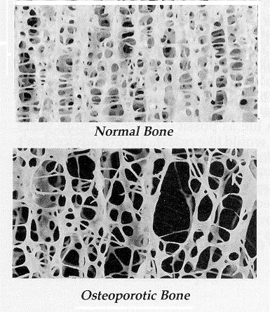 OSTEOPOROS Ett tyst tillstånd.