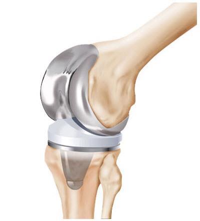 Hel knäprotes (böjd knäled) Metall Lårben Plast Metall Skenben Vadbenet Förväntat resultat Syftet med operationen är att få en smärtfri knäled med ökad rörlighet och