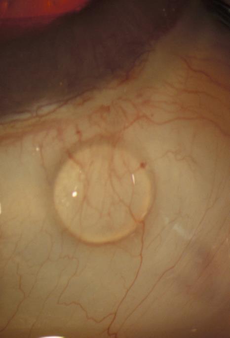 SIBS and silicone rubber implanted