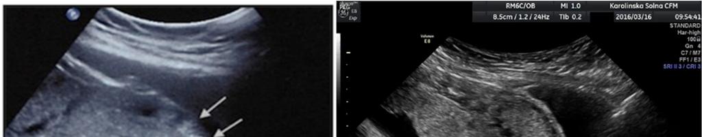 Placenta accreta/ increta/ percreta:benäms