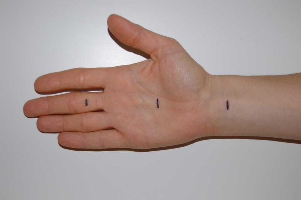 Sensorisk amplitud mättes till potentialernas negativa peak från en linje dragen mellan potentialernas första och andra positiva peak.