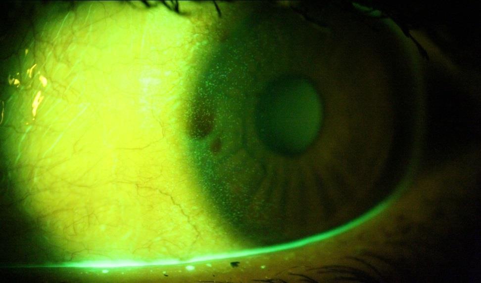 1.3.1 Corneal staining Corneal staining ses både hos kontaktlinsbärare och icke kontaktlinsbärare men det är vanligare vid användandet av kontaktlinser.