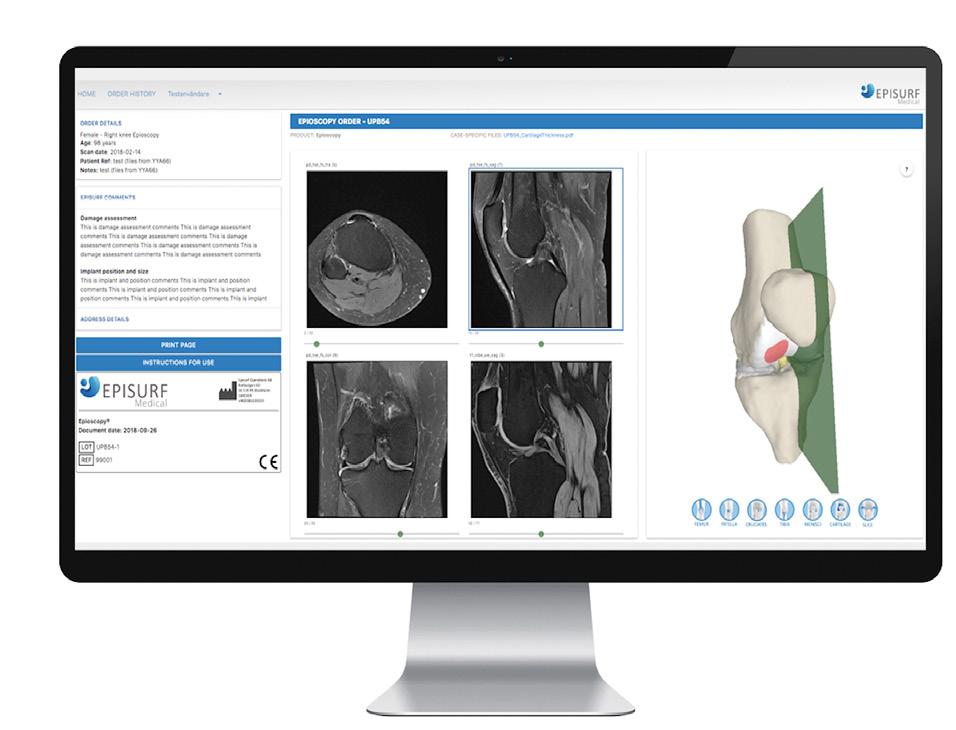 Operation med ett Episealer Trochleaimplantat hos PD Dr.
