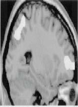 Frontal lesions Disorders of cognitive functions: -planning -inhibition -memory working memory (hold information in memory)