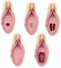 vulva vestibulära papiller