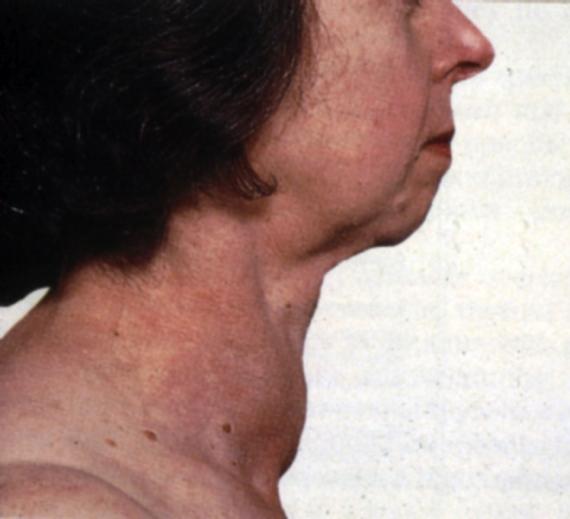 Autoimmuna thyroiditer Graves sjukdom Associerad