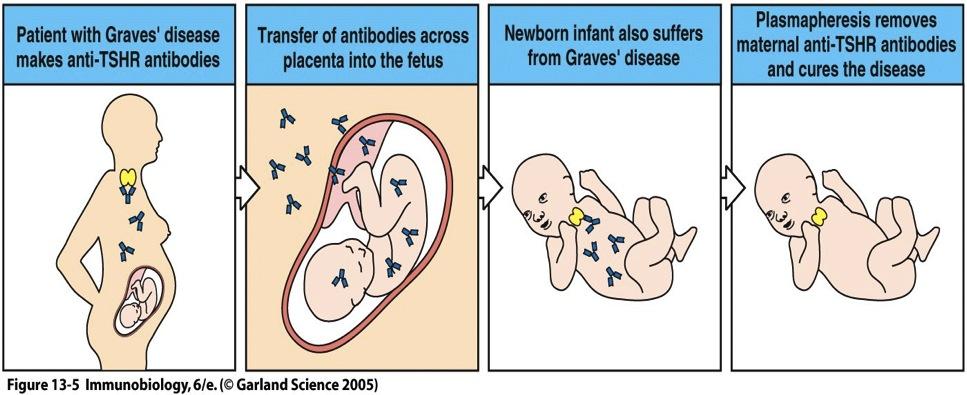 Grave s disease in the newborn Antikroppar kan