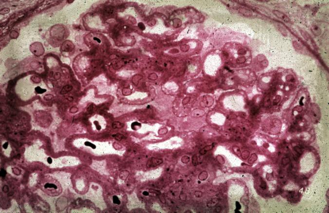 Förtjockade basalmembran i glomerulära