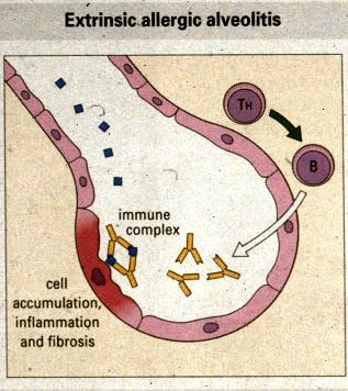 Allergisk alveolit orsakas av immunkomplex i alveolerna Yrkesmässig exponering för anbgen ( oca från mögel) i inandningslucen kan