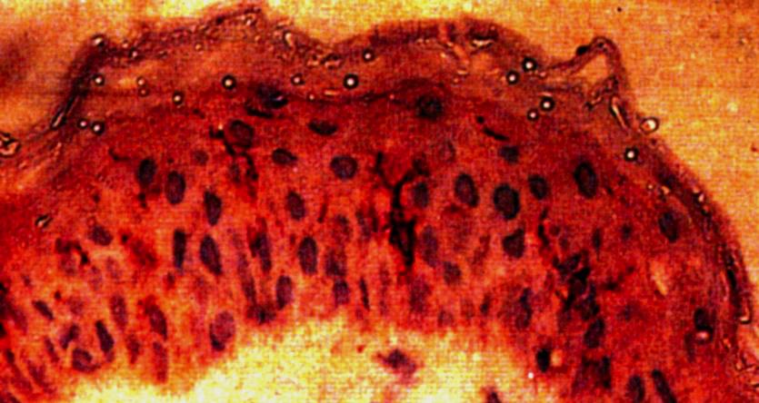 DendriBska celler av Langhansk typ