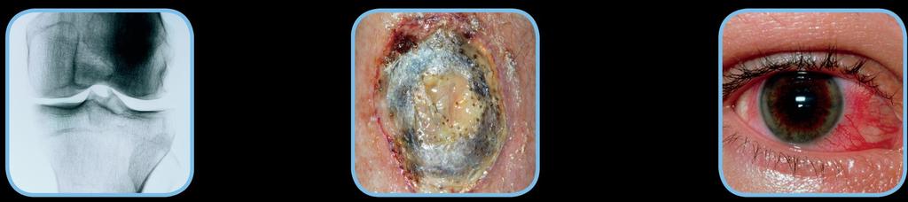 Crohns Sjukdom och extraintestinala manifestationer Leder Arthralgia Peripheral arthritis Ankylosing spondylitis